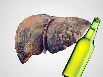 Role of Alcohol in Liver Cirrhosis