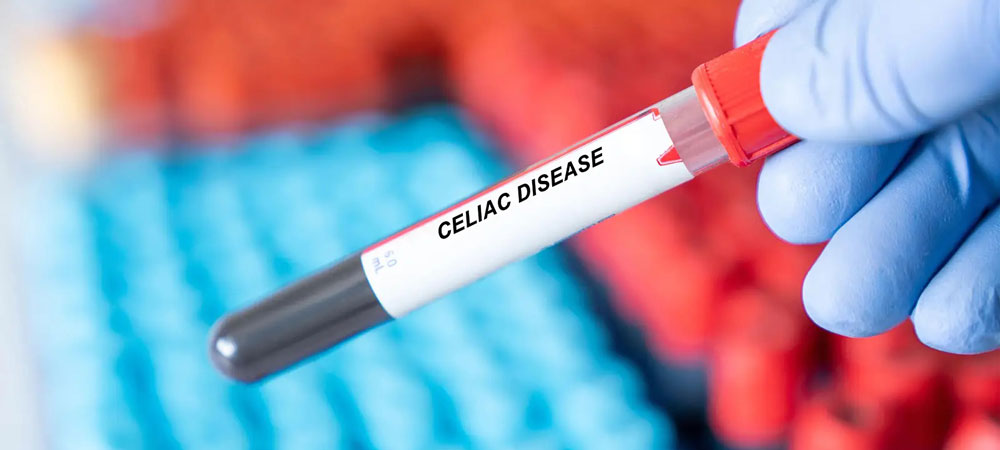 Celiac Disease: All You Need To Know