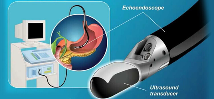 Best Endoscopic Procedures for GI in Hyderabad